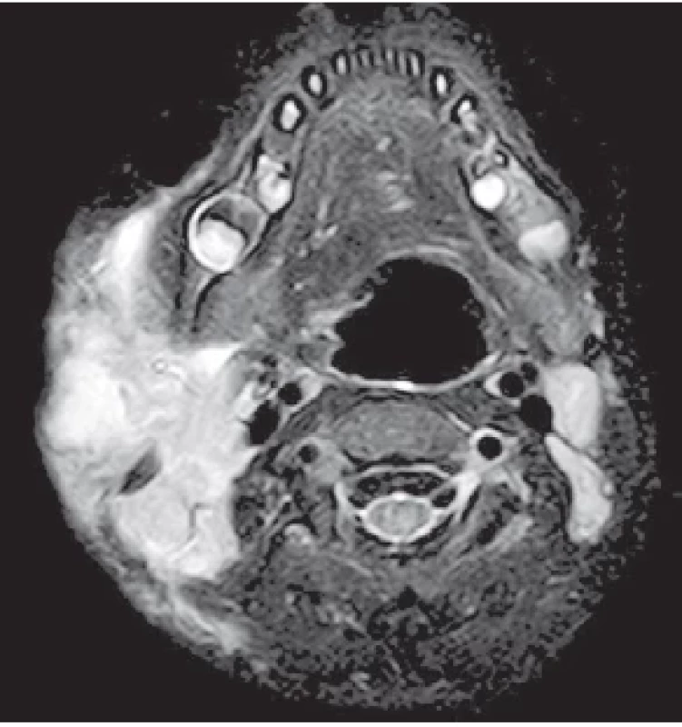 Snímek z magnetické rezonance (transverzální řez, STIR
sekvence) s nálezem abscedující lymfatické uzliny preaurikulárně
vpravo