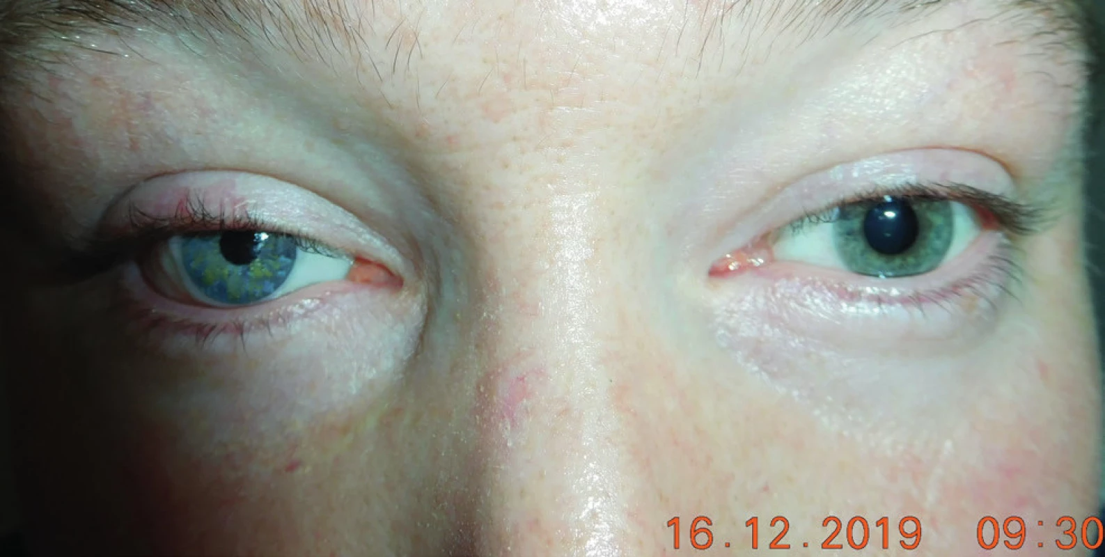 Macro-photo – patient with application of individual prosthesis in right eye in 2019