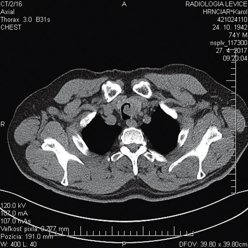 CT zobrazenie tumoru v subglotickej oblasti laryngu
a proximálnej trachey vľavo.