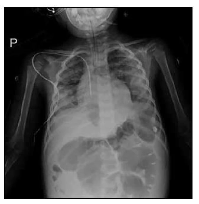 Oboustranná pneumonie s pleurálním
výpotkem. Nález na plicích u komplikovaného
průběhu chřipky primárně rizikového šestiletého
pacienta. [Foto: archiv autorky]