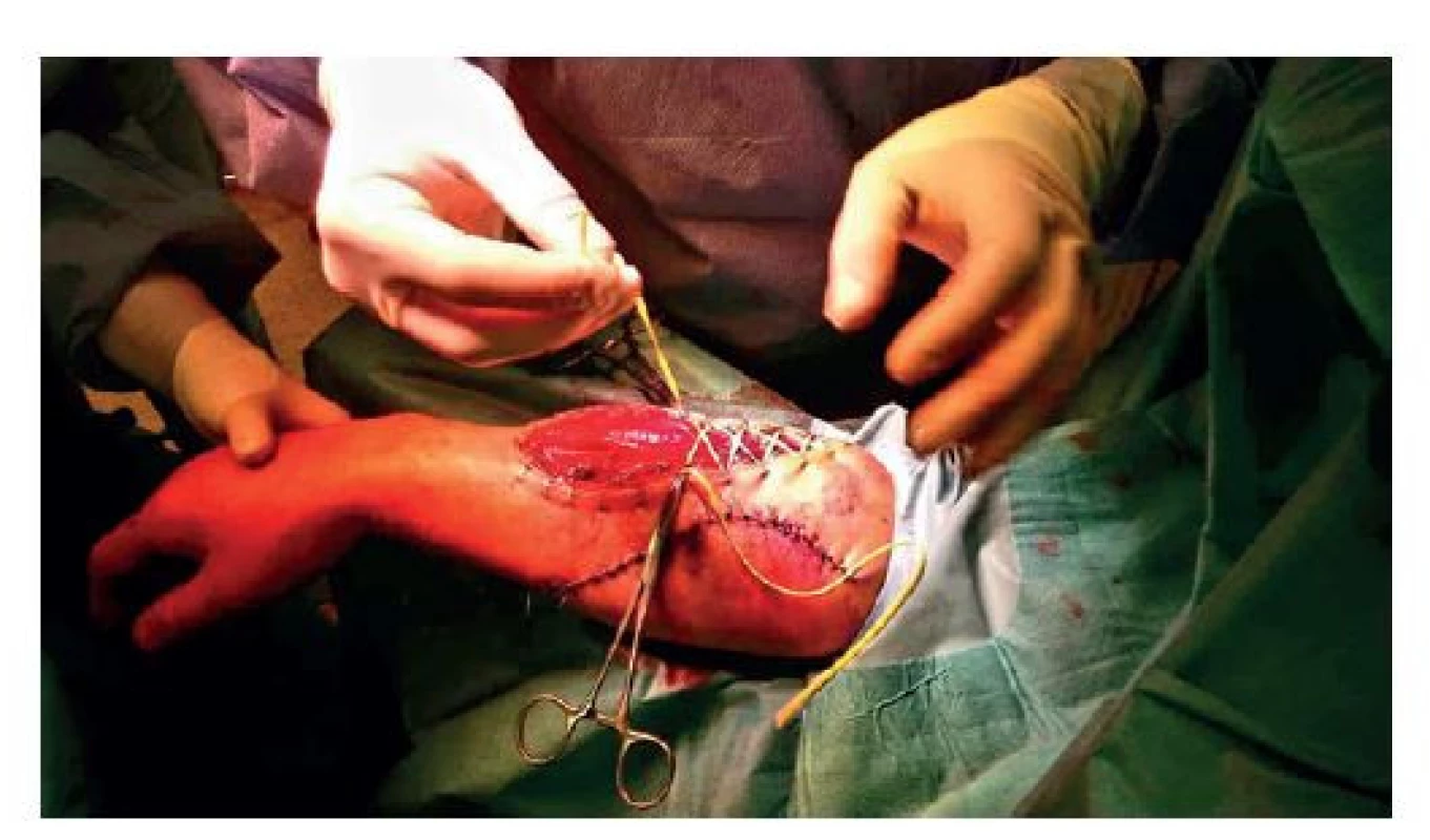 Zakládání elastické ligatury dorzální rány LHK,
částečně zachycena kompletní sutura rány ventrálního
kompartmentu<br>
Fig. 4: Elastic ligature of the dorsal wound on the left
upper limb; partial view of complete suture of the ventral
compartment