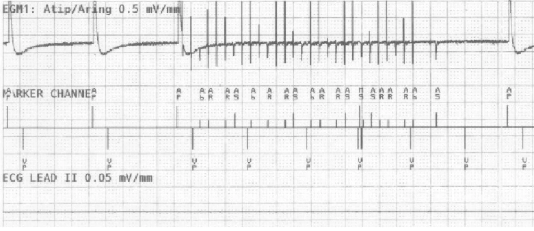 The recording of near-field channel of bipolar
atrial lead during EMI simulation detected as atrial
fibrillation. N.B.: Marker AP = Atrial Pace, AR/AB =
Atrial Refractory/Blanking, VP = Ventricular Pace,
MS = Mode Switching.