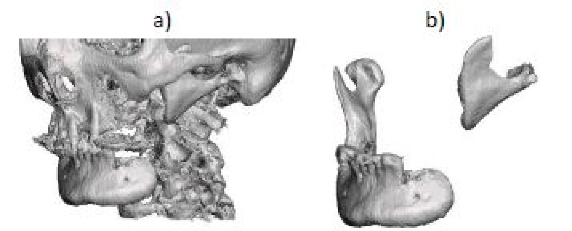 Showing a) reconstructed surface 3D model of the mandible and b) extracted 3D model of the mandibular defect.