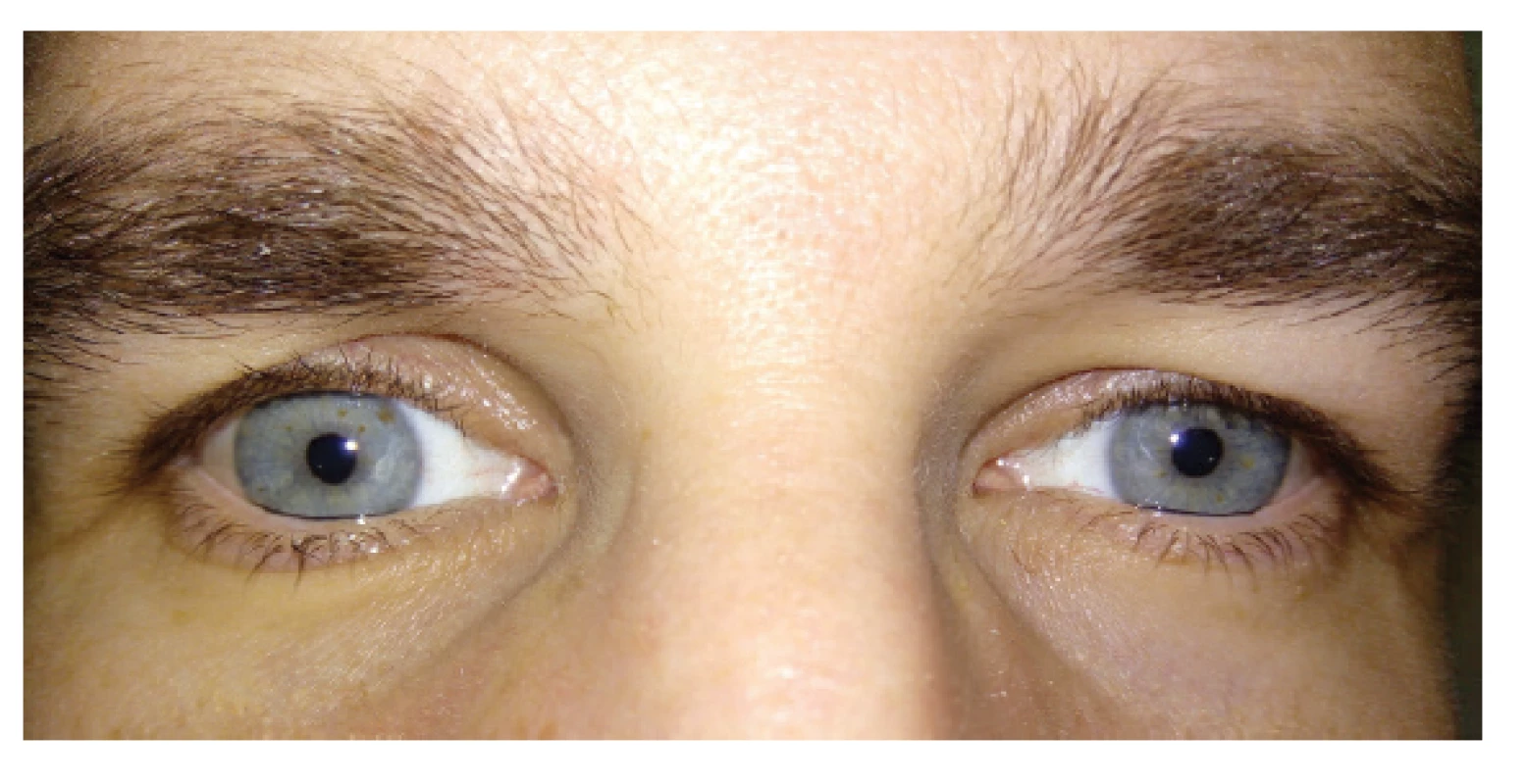 Symmetry of the upper eyelids of both eyes 1 year after
antrostomy