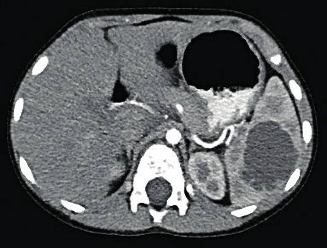 CT obraz sleziny s centrálne uloženou cystou.<br>
Fig. 1. CT scan of the spleen with the cyst centrally located.
