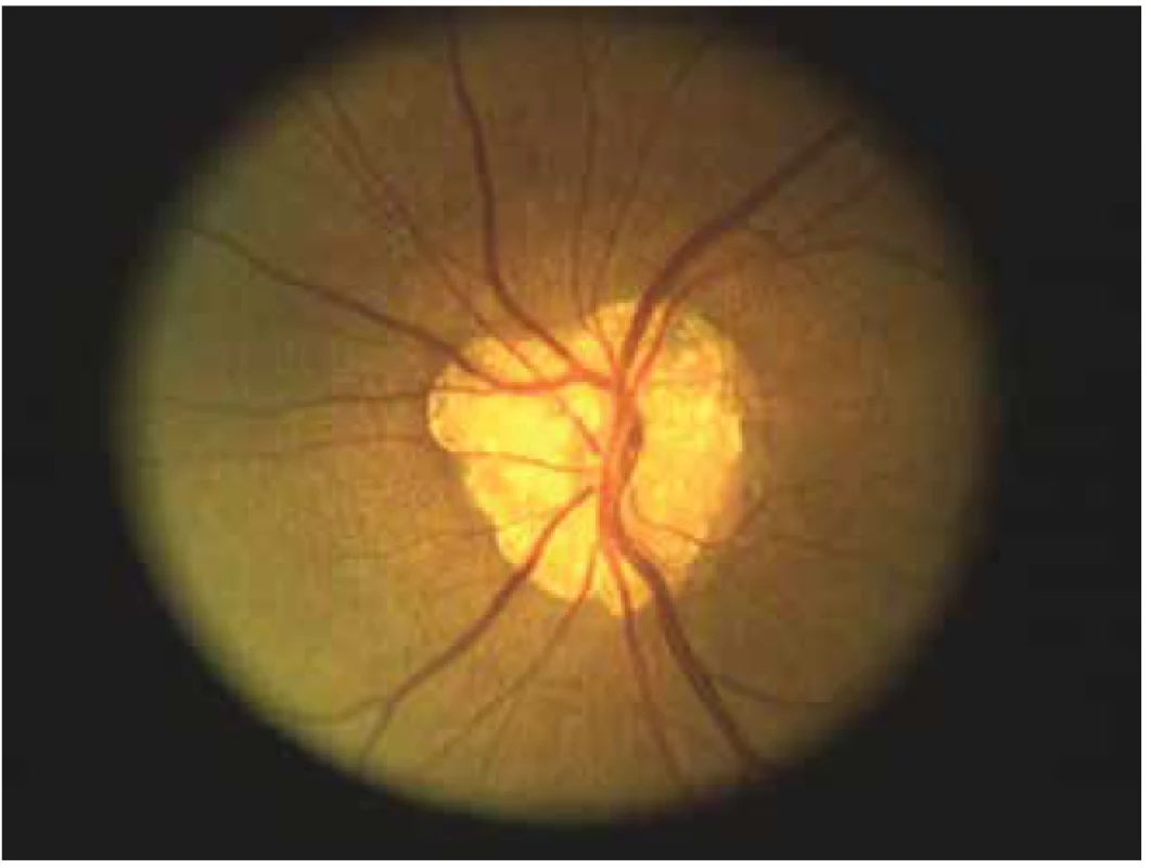 Foto veľkého komplexu drúz terča optického
nervu