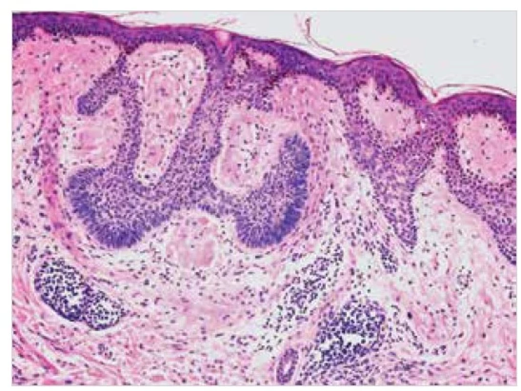 Sekundární kožní amyloidóza – histopatologie<br>
Eozinofilní depozita ve stromatu bazaliomu. Barvení HE, původní
zvětšení 100krát.
