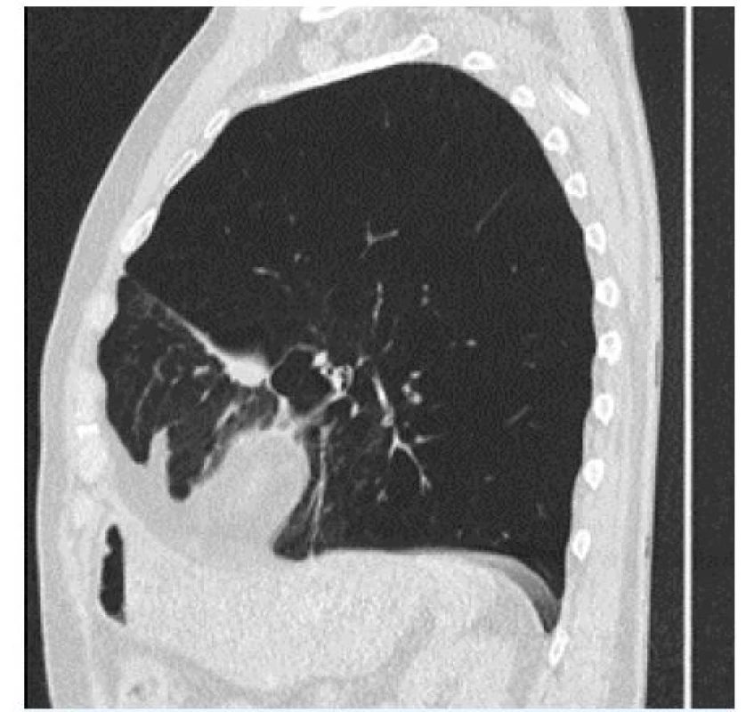  CT nález pacienta s heterogenním emfyzémem s převahou v dolním laloku levé plíce