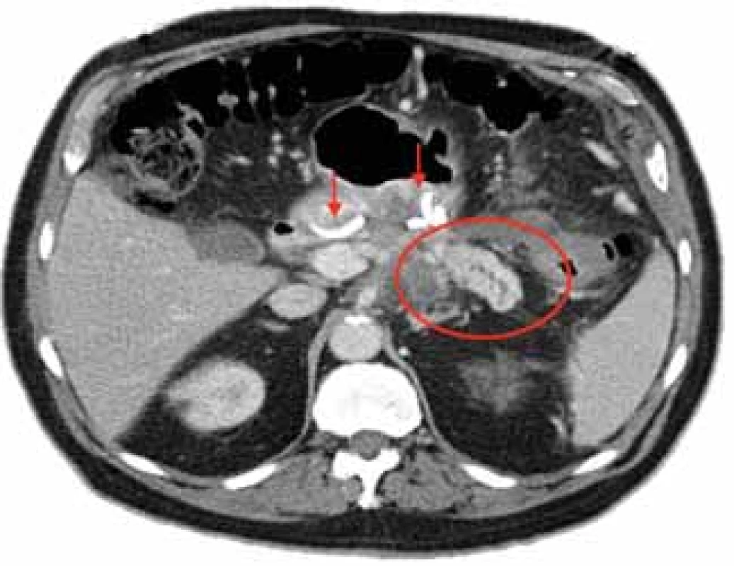 Izolovaný distální pankreatický segment s rozšířeným vývodem v terénu nekroticky spotřebovaného těla pankreatu u pacienta po endoskopické drenáži WON. Ponechány dva DPS (šipky). Použito se svolením R. Attama,
Kaiser Permanente, CA, USA.<br>
Fig. 5. An isolated distal pancreatic segment with duct dilatation in the setting of pancreatic body necrosis in a patient after endoscopic drainage of WON. Two DPSs left in place (arrows). Courtesy of R Attam, Kaiser Permanente, CA, USA.
