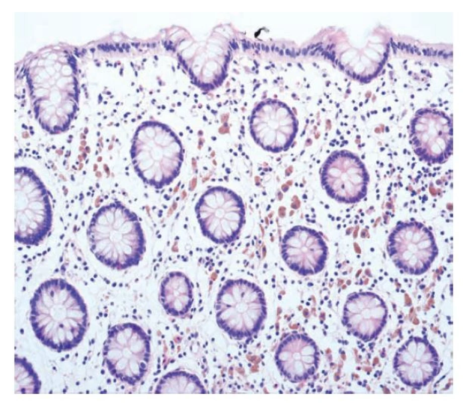 Melanosis coli. Melanosis coli s přítomností početných pigmentovaných
makrofágů v lamina propria (hematoxylin a eosin; 200x).