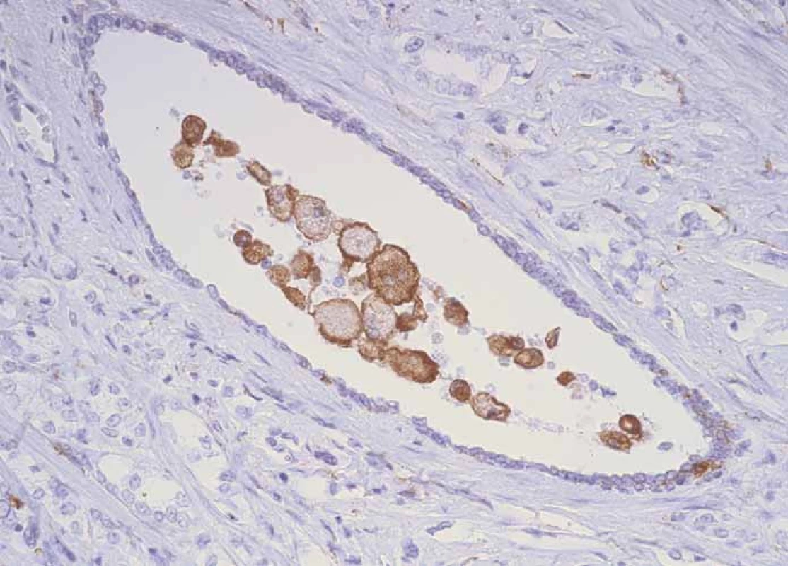 CD204+ macrophages inside ductus crossing structures of prostate cancer.