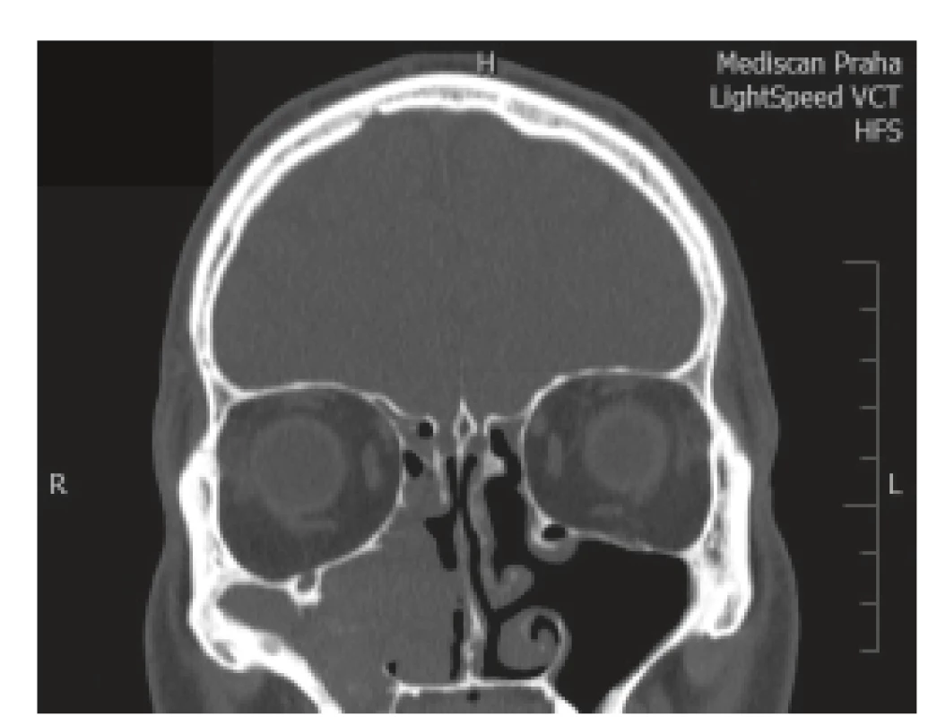 Hyperostitické změny postihující
difúzně laterální a dolní stěnu maxilárního sinu
u pacienta s recidivou IP.