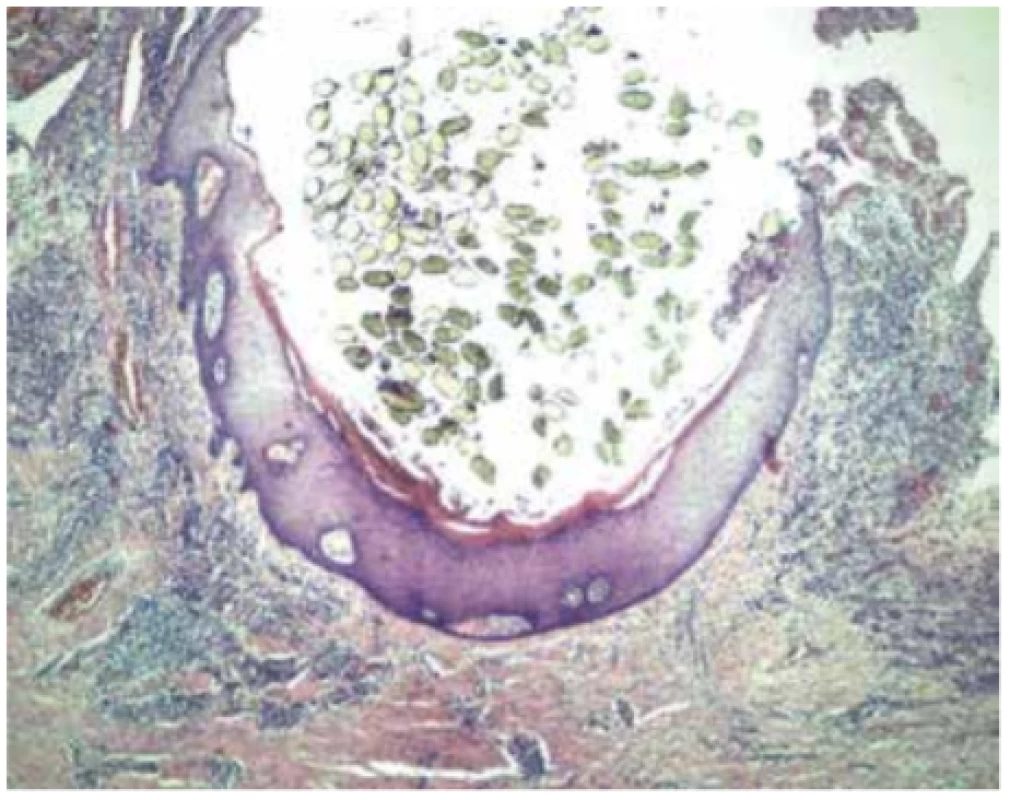 Histologický obraz pilonidálního sinu (archiv autorů)<br>
Fig. 3: Histologicalviewofpilonidal sinus (authors´ archive)