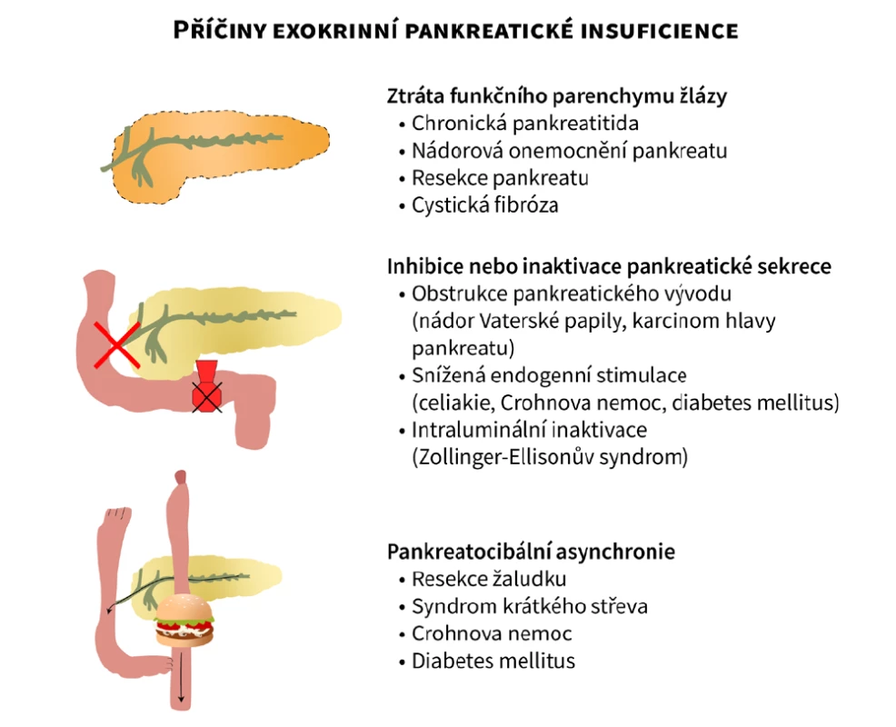 Schéma jednotlivých příčin exokrinní pankreatické insuficience. Upraveno dle Keller et al. (28), vytvořeno ve spolupráci se Servisním střediskem
pro e-learning, Fakulta informatiky Masarykovy univerzity