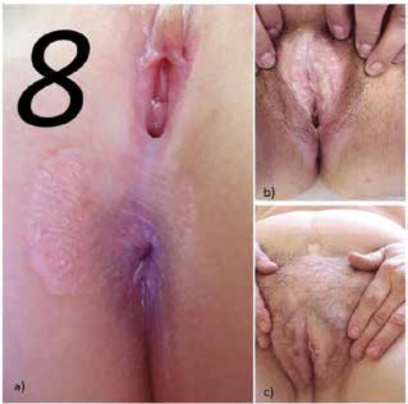 Postižení perinea spojující postižení perianální a perivaginální připomíná číslici 8 (a), atrofie a jizvení labií s přechodem do třísel (b), postižení genitálu s hemoragiemi a Koebnerovým fenoménem v operační jizvě na břichu (c)