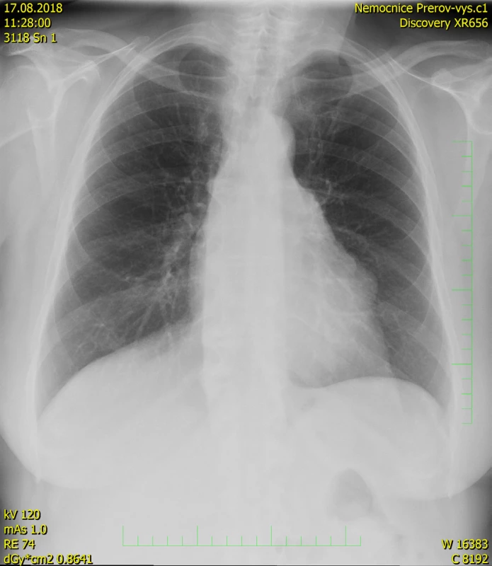 RTG snímek hrudníku – vyklenutí levé srdeční kontury