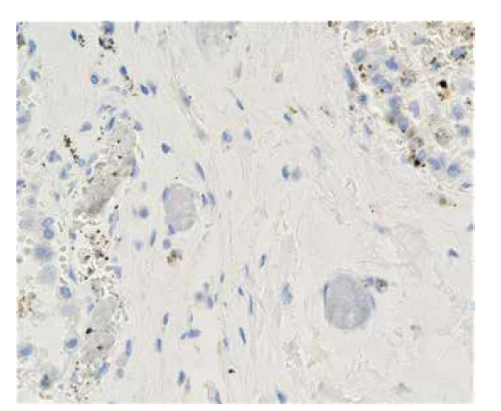 Případ č. 2. Negativní imunohistochemicky průkaz CD61 v embolizovaném
polymeru (zvětšeno 400x).