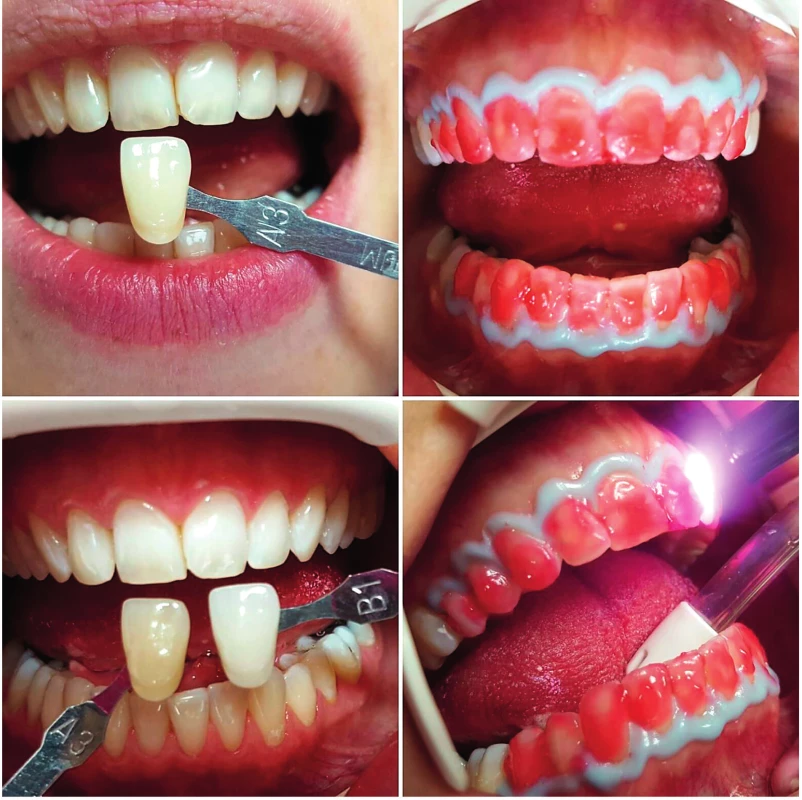 Bielenie zubov laserom z A3,5 na B1, použitá multitip koncovka s bieliacim médiom (autor snímky:
Kyjovská Čičváková)