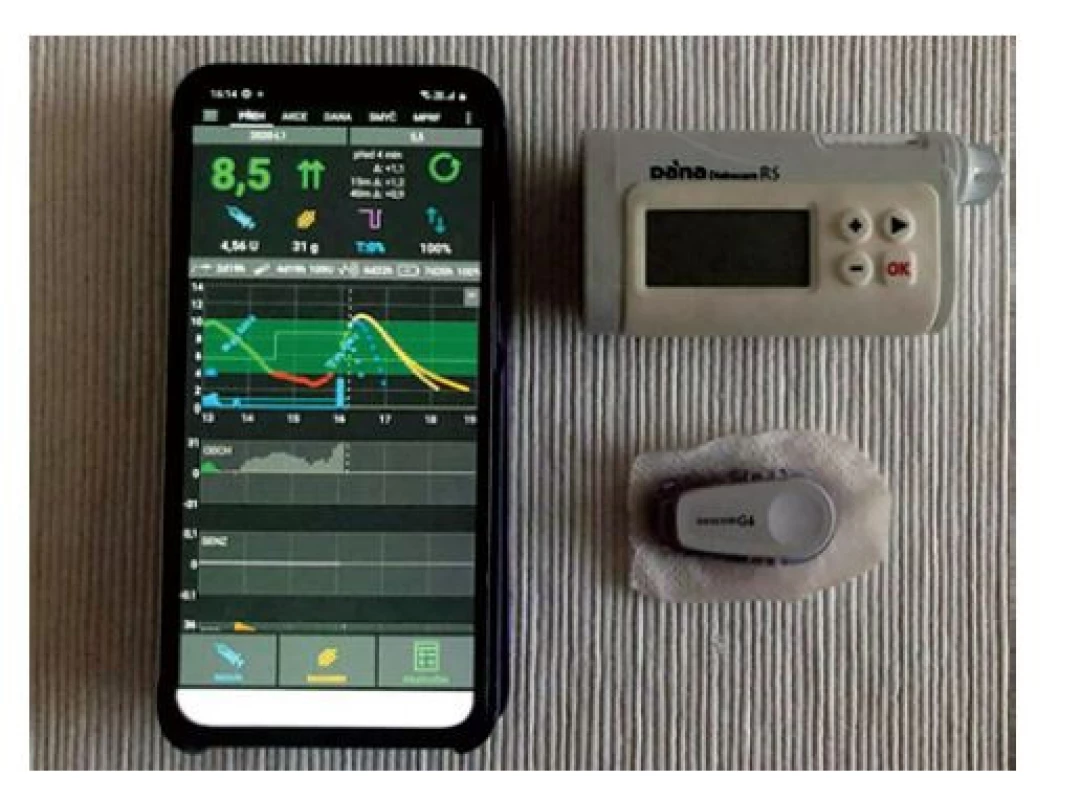 Automatický systém AndroidAPS testovaný jako „zcela
uzavřená smyčka“ skládající se z telefonu s algoritmem
umělé slinivky, CGM a inzulinové pumpy