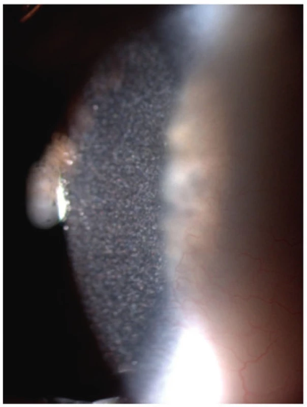 Krystalky cystinu v rohovce
u 2,5letého chlapce
s infantilní cystinózou
a projevy fotofobie.<br>
Fig. 5. Cystine crystals in cornea
of 2.5-year-old boy with
infantile cystinosis and
photophobia.