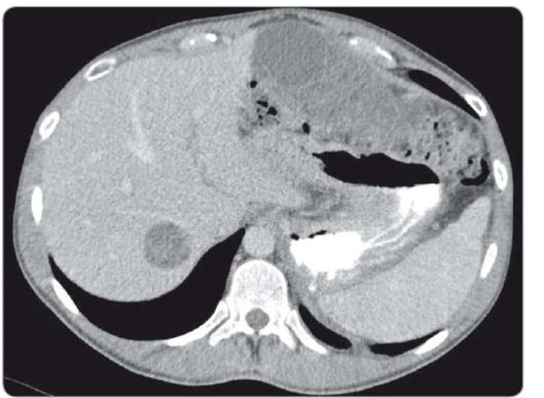 scan of liver metastasis located in the segment VII.