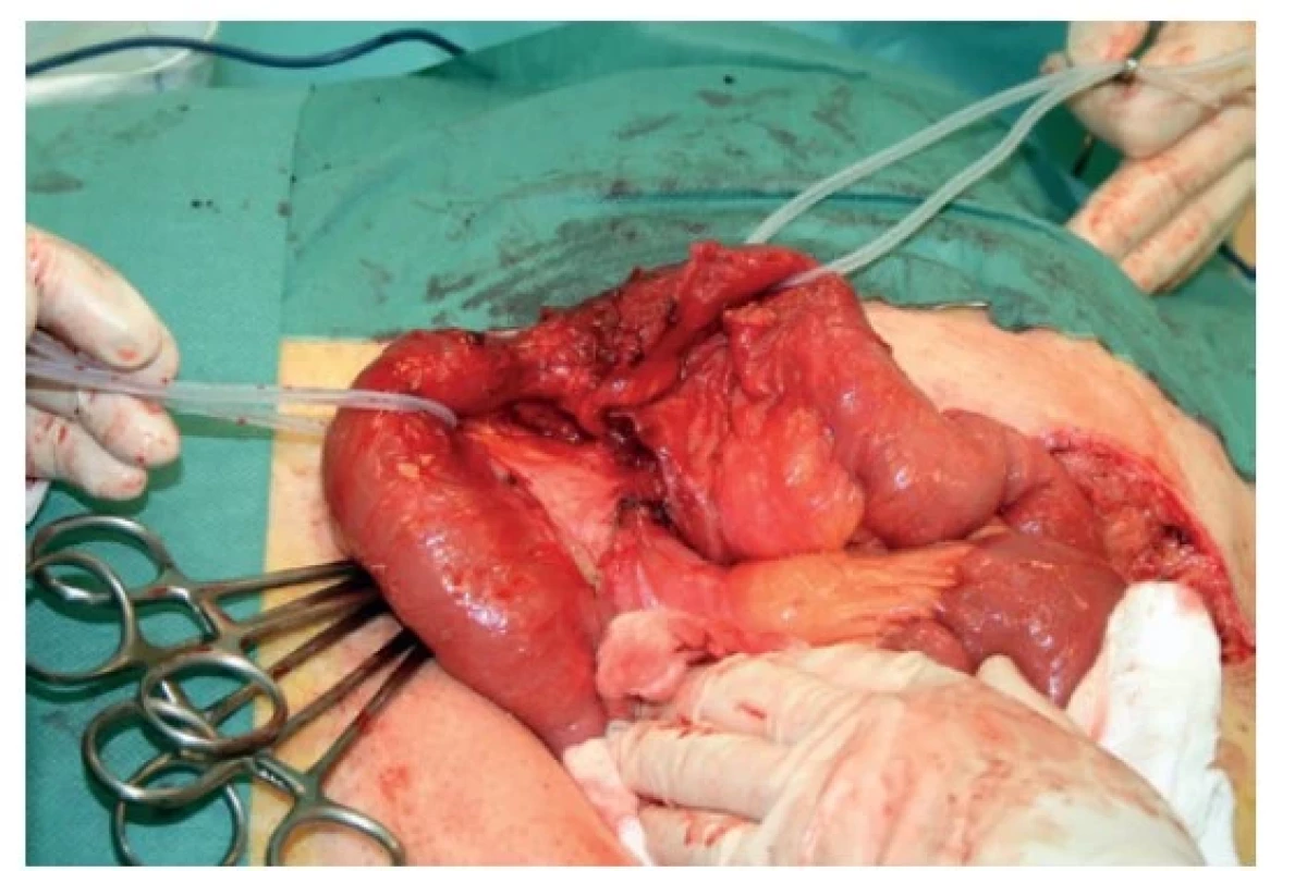 Strangulační ileus tenké kličky 5 let po resekci rekta
pro karcinom<br>
Fig. 1: Strangulated small bowel obstruction 5 years after
rectal carcinoma resection