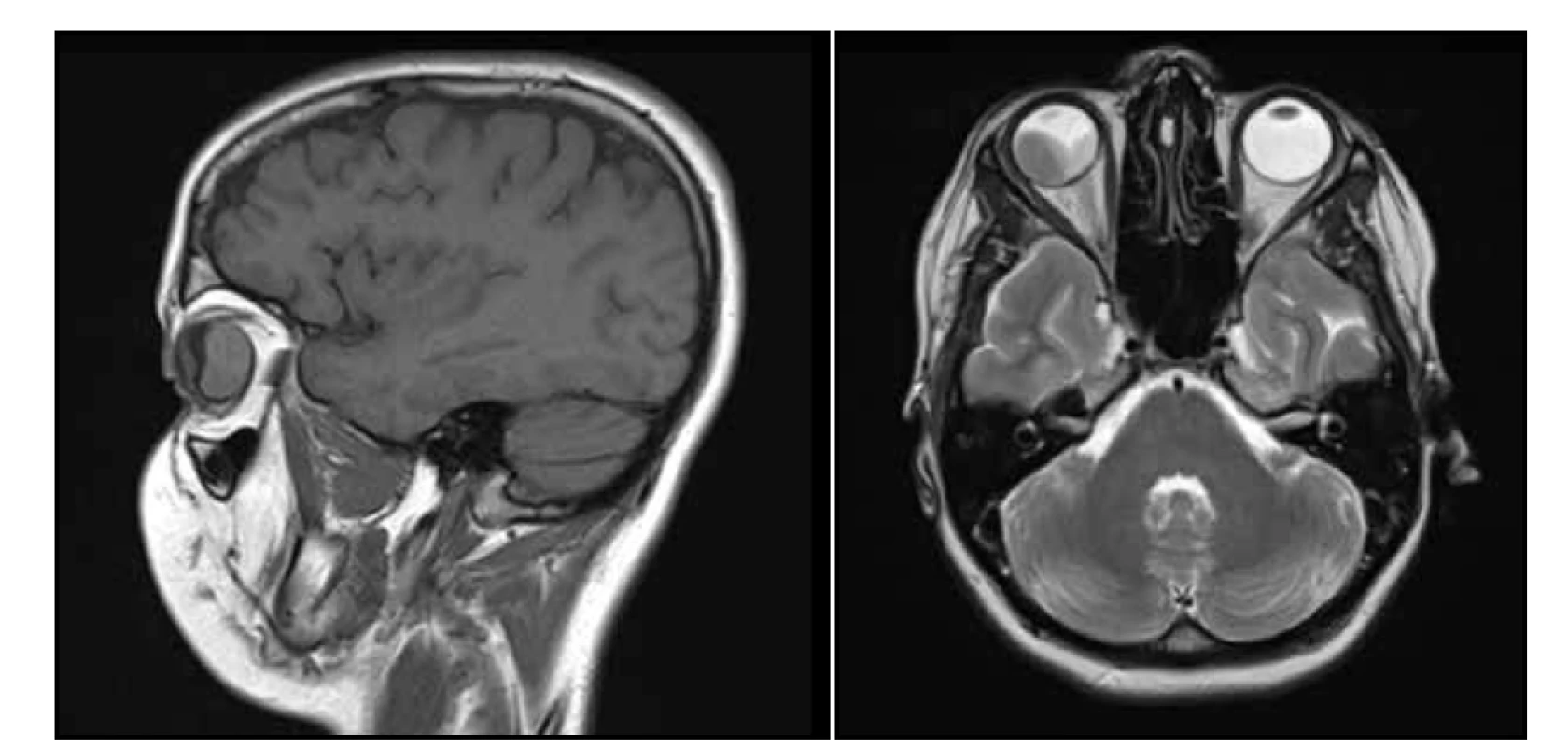 Magnetická rezonance hlavy snímek sagitální (A) a transversální (B) – v pravé části pravého bulbu solidní, měkkotkáňová
léze čočkovitého tvaru s postkontrastním výrazným sycením, levá a kaudální porce bulbu je vyplněna subretinálním
hematomem, bez kalcifikací