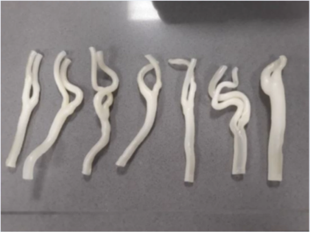 Vytištění karotického řečiště z 3D rekonstrukce CT angiografických snímků (7 pacientů)<br>
Figure 2. Printing of the carotid artery from 3D reconstruction of CT angiographic images (7 patients)