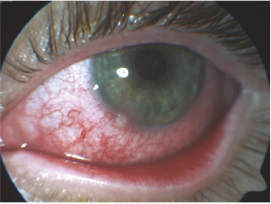 Right eye of patient from case report 1, mixed injection of conjunctiva with incipient corneal ulcer by no. 7