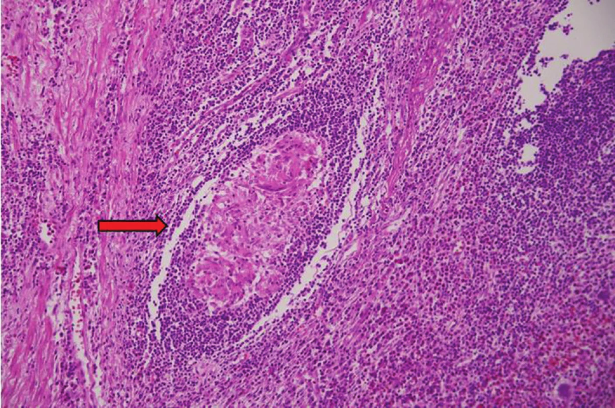 Histologie z resekátu<br>
Apendix v barvení hematoxylinem − eozinem ve 200x zvětšení
– epiteloidní granulom (označen šipkou) – histologicky
typický pro Crohnovu chorobu.<br>
(Bennet R., Oddělení patologie, Nemocnice Hořovice)<br>
Fig. 3: Resected specimen histology<br>
Appendix in hematoxylin − eosin staining, 200x magnifi cation
− epitheloid granuloma (marked by arrow) – histologically
typical for Crohn´s disease.<br>
(Bennett R., Department of Pathology, Hořovice Hospital)