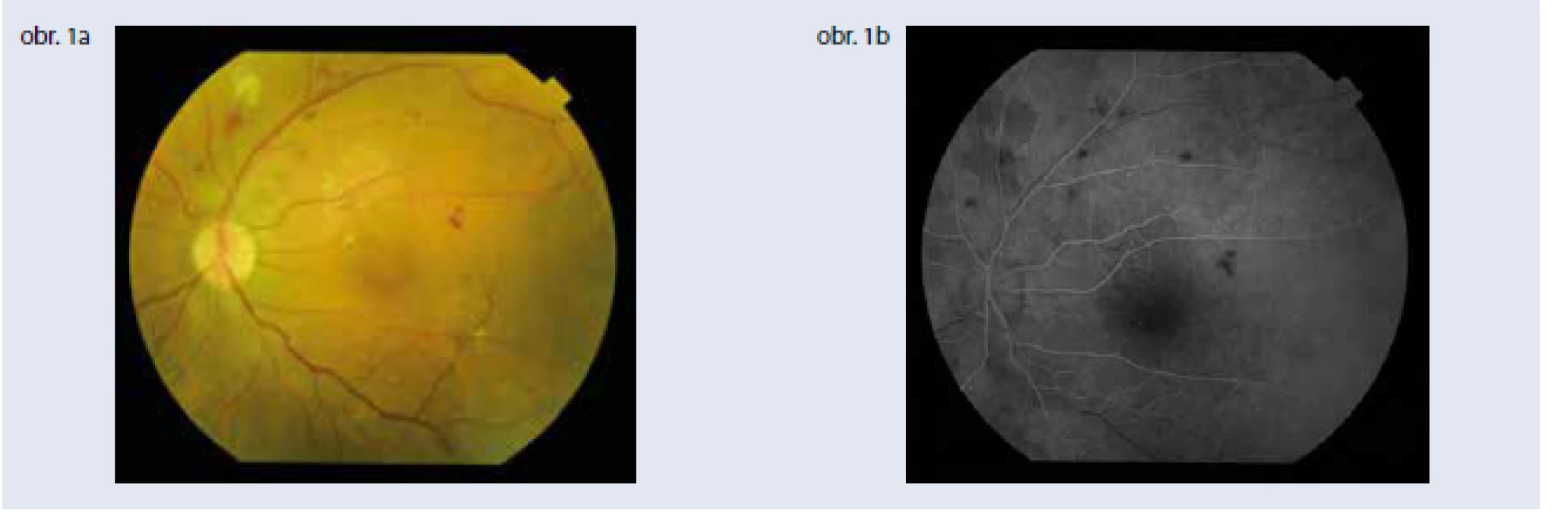 Klinické parametre a štandardná zobrazovacia vyšetrovacia metóda – fluoresceínová angiografia –
sú stále základom diagnostiky diabetickej retinopatie. Obr. 1a | Závažná neproliferatívna diabetická
retinopatia Obr. 1b | Fluoresceínová angiografia závažnej neproliferatívnej diabetickej retinopatie,
artério-venózna fáza. Archív autorky