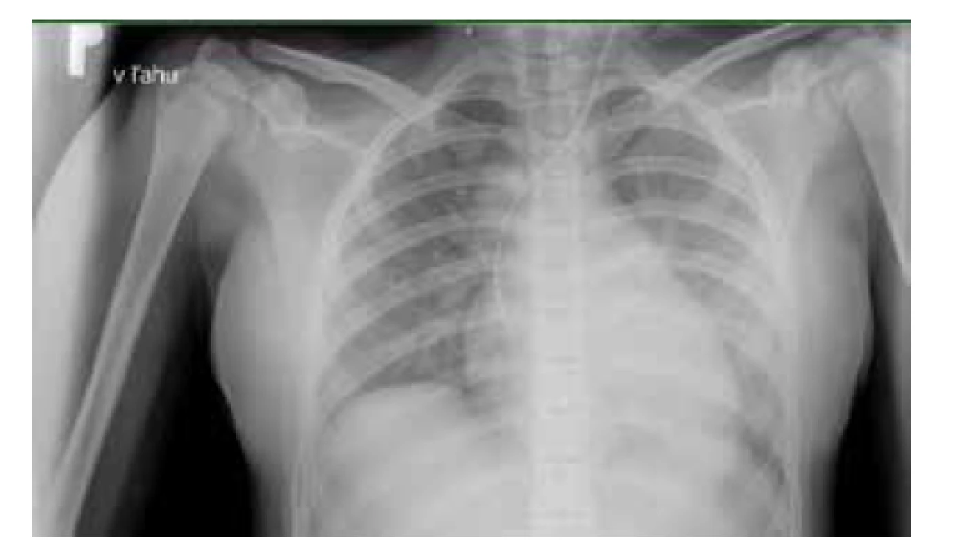 RTG vyšetrenie pľúc pacientky z klinického prípadu 2
– obraz bilaterálnej bronchopneumónie.<br>
Fig. 4. X-ray examination of the patient’s lungs from case report
2 – bilateral bronchopneumonia.