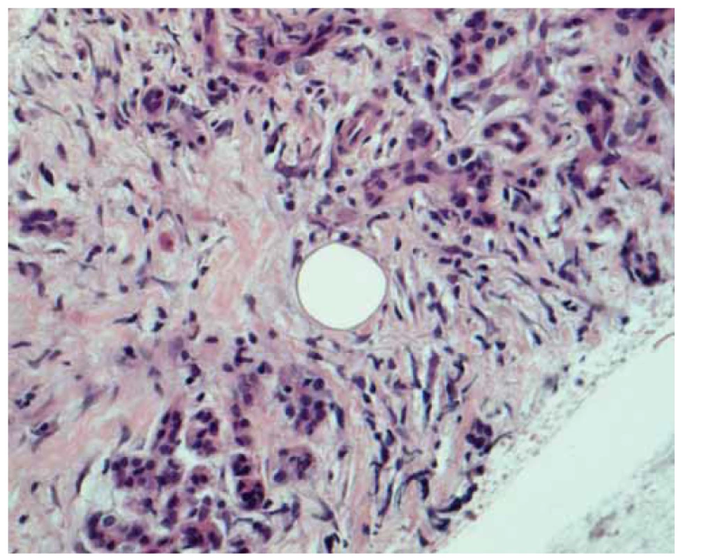 Histologický nález: glandulárny parenchým pankreasu s lymfoidnými
bunkami, ktoré sú zmesou CD3+ T-lymfocytov a CD 20+ B-lymfocytov.<br>
Fig. 4. Histological finding: glandular parenchyma of the pancreas with lymphoid
cells, which are a mixture of CD3+ T-lymphocytes and CD 20+ B-lymphocytes.