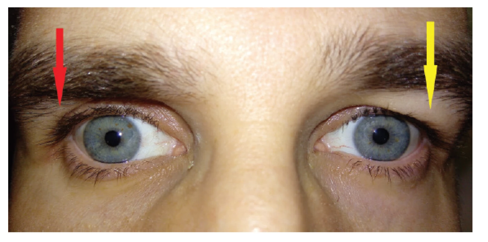 Blefarochalasis of the left eye, deep orbitopalpebral sulcus
on right eye