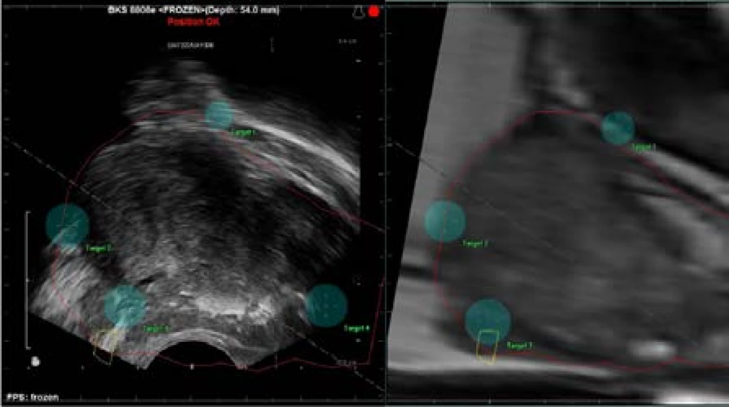 Koregistrace MRI a TRUS obrazu<br>
Fig. 4. Co-registration MRI and TRUS image