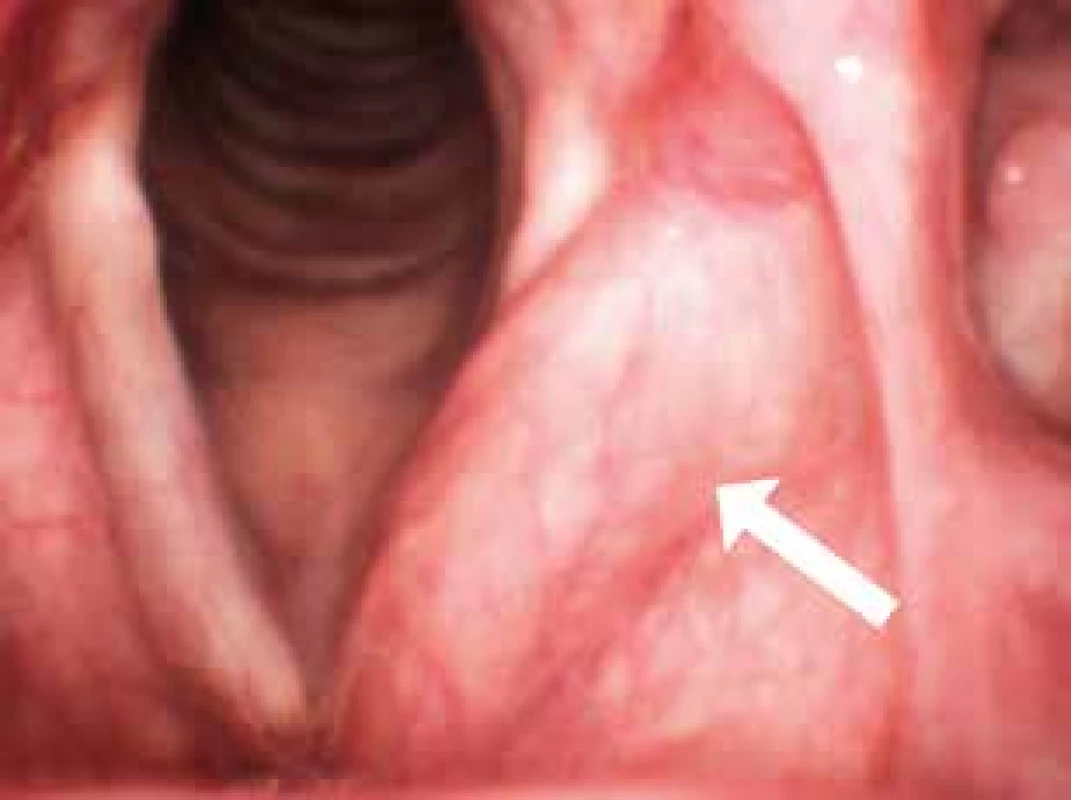  Vnitřní laryngokéla