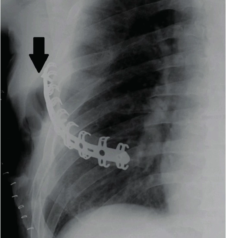 Partial failure of osteosynthesis (release of the locking screw –
see the arrow), which did not result in mechanical failure of the osteosynthesis; the patient achieved full bone healing, the screw migration
did not continue