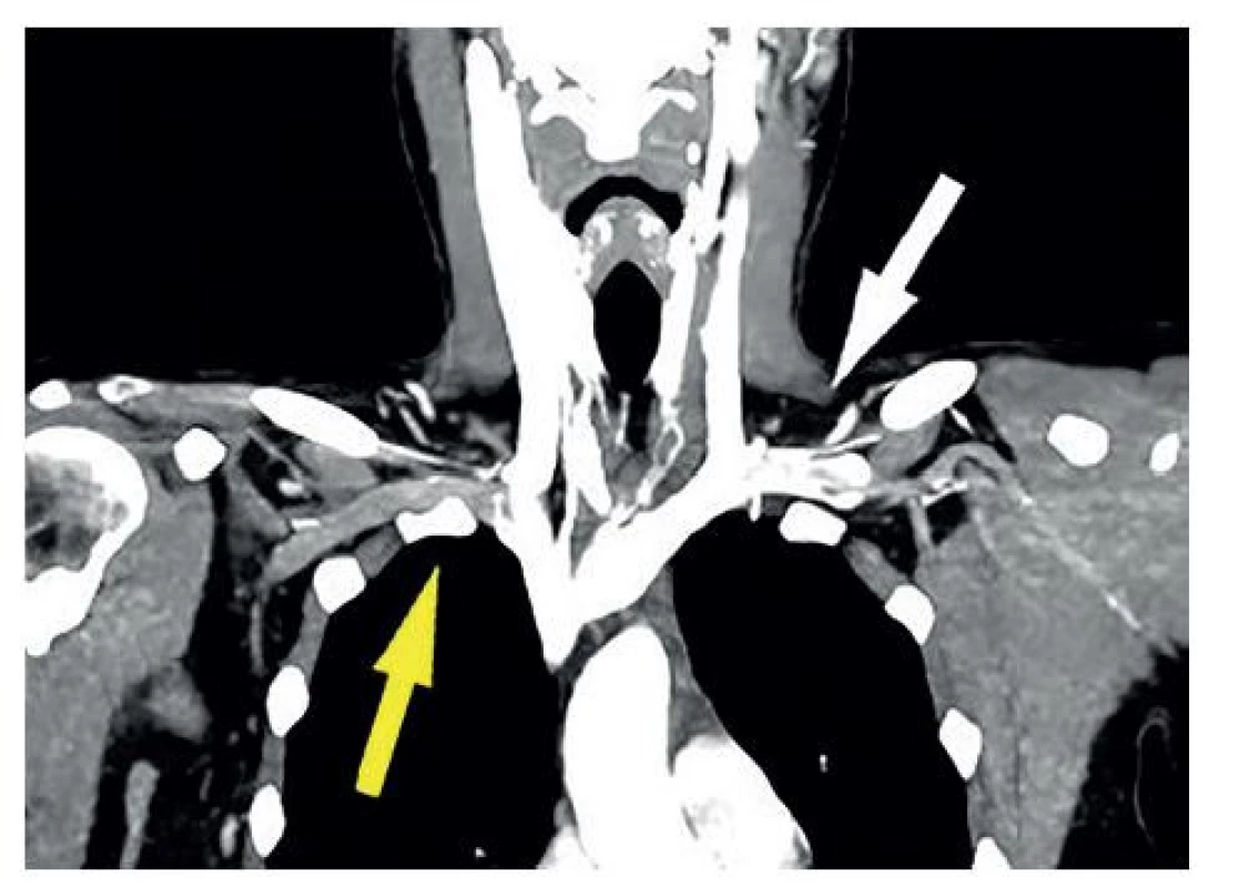Angio CT – frontální rekonstrukce<br>
Útlak subklaviální žíly vpravo prvním žebrem (žlutá šipka) proti
neporušené náplni kontralaterální subklaviální vény (bílá šipka).<br>
Fig. 1: Angio CT – frontal reconstruction<br>
Left subclavian vein compression (yellow arrow) vs. intact
contralateral subclavian vein (white arrow).