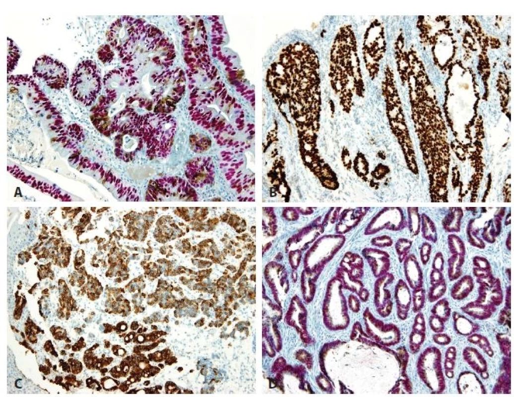 Immunohistochemical findings. A. High-grade hybrid dysplasia with nuclear CDX2 positivity (red) and cytoplasmic MUC5AC
expression (brown) in cells. No cell with negativity of CDX2 and positivity of MUC5AC is seen. B. Esophageal adenocarcinoma of
intestinal type shows CDX2 nuclear positivity. C. Esophageal adenocarcinoma of foveolar gastric type is positive for MUC5AC. D.
Esophageal adenocarcinoma of hybrid type. The nuclei are positive for CDX2 (red) and cytoplasm for MUC5AC (brown). No cell with
negativity of CDX2 and positivity of MUC5AC is seen (original magnifications 400x in A, 100x in B-D, respectively).