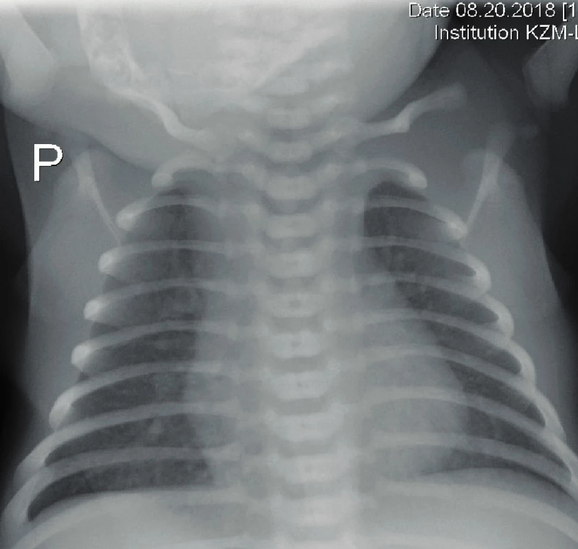 Rentgen hrudníku – normální nález na plicích ve věku
13 dní.<br>
Fig. 2. X-ray of the chest – normal finding at the age
of 13 days.