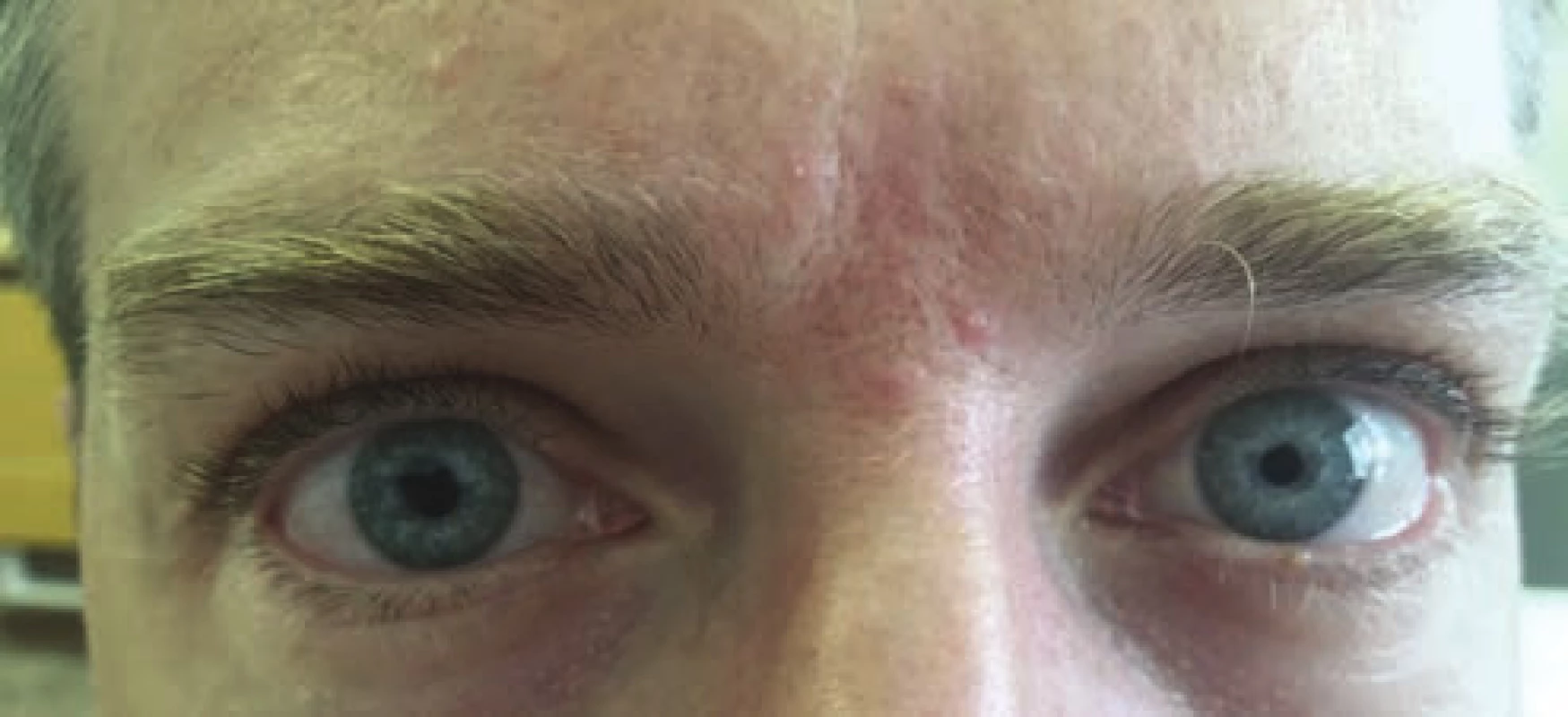 Patient with anisocoria in right eye