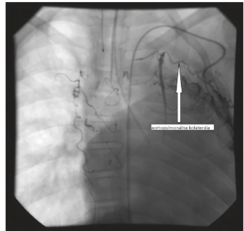 Angiografia s nástrekom kontrastnej látky do ľavej
podkľúčnej tepny so znázornením 1 aorto-pulmonálnej
kolaterály (pacient 2).<br>
Fig. 3. Injection in a left subclavian artery showing 1 aortopulmonary
collateral vessel (patient 2).