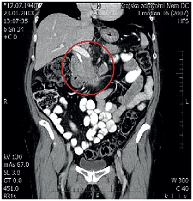 MDCT s nálezem tumoru hlavy pankreatu
V červeném kruhu zachycena oblast hlavy pankreatu. <br> 
Fig. 1: MDCT with pancreatic head tumor
The pancreatic head is captured in the red circle.
