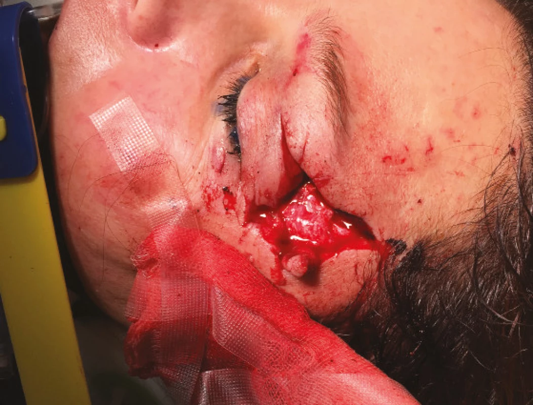 Deep wound of periocular region and upper eyelid in
patient following traffic accident