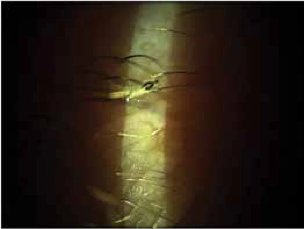  Individual Oestrus ovis larva on edge of eyelid