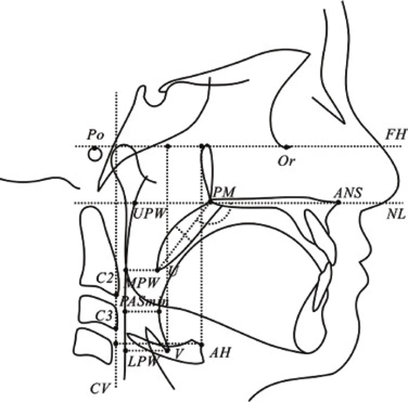 Cephalometric analysis and UR tract measurement used in the determination of cephalometric standards in 12-year-olds; taken from Min GU et al. [51]
Po – porion, Or – orbitale, ANS – anterior nasal spine, PM – pterygo-maxillare, U – uvula, UPW – upper pharyngeal wall, MPW – middle pharyngeal wall, LPW – lower pharyngeal wall, V – vallecula, AH – anterior hyoid, C2 and C3 - 2nd and 3rd cervical vertebrae, FH – Frankort horizontal plane, NL – nasal line, CV – cervical vertebrae, the line joining the C2 and C3
