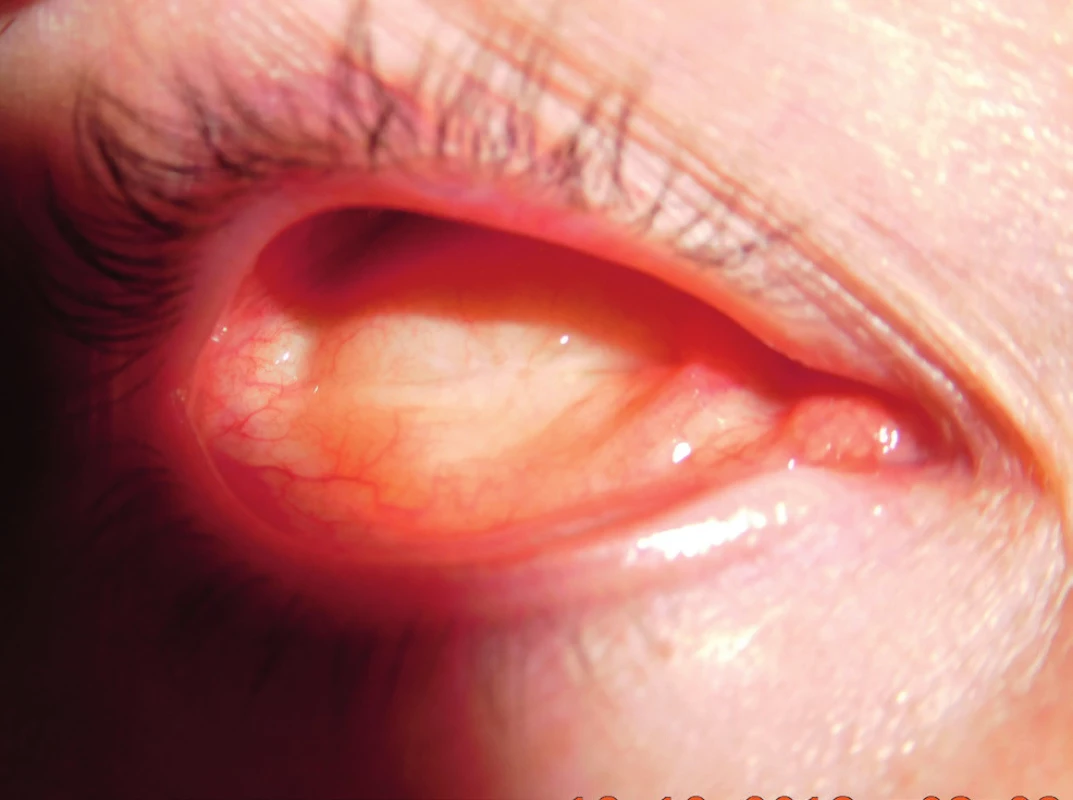 Clinical finding, condition after enucleation – conjunctival sac without recurrence in 2019