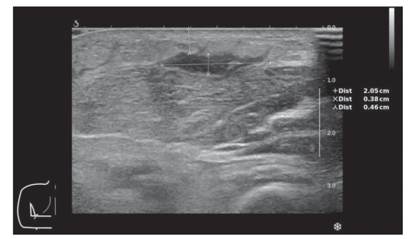 Kožní forma mukormykózy – ultrazvukové zobrazení abscesu v podkoží
na volární straně předloktí levé horní končetiny.