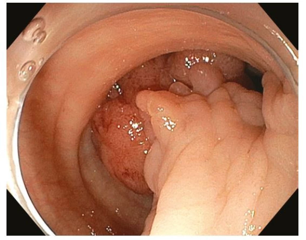 Endoskopická polypektomie – objemný stopkatý polyp 0-Ip sigmoidea
diagnostikovaný u pacienta s hematochezií