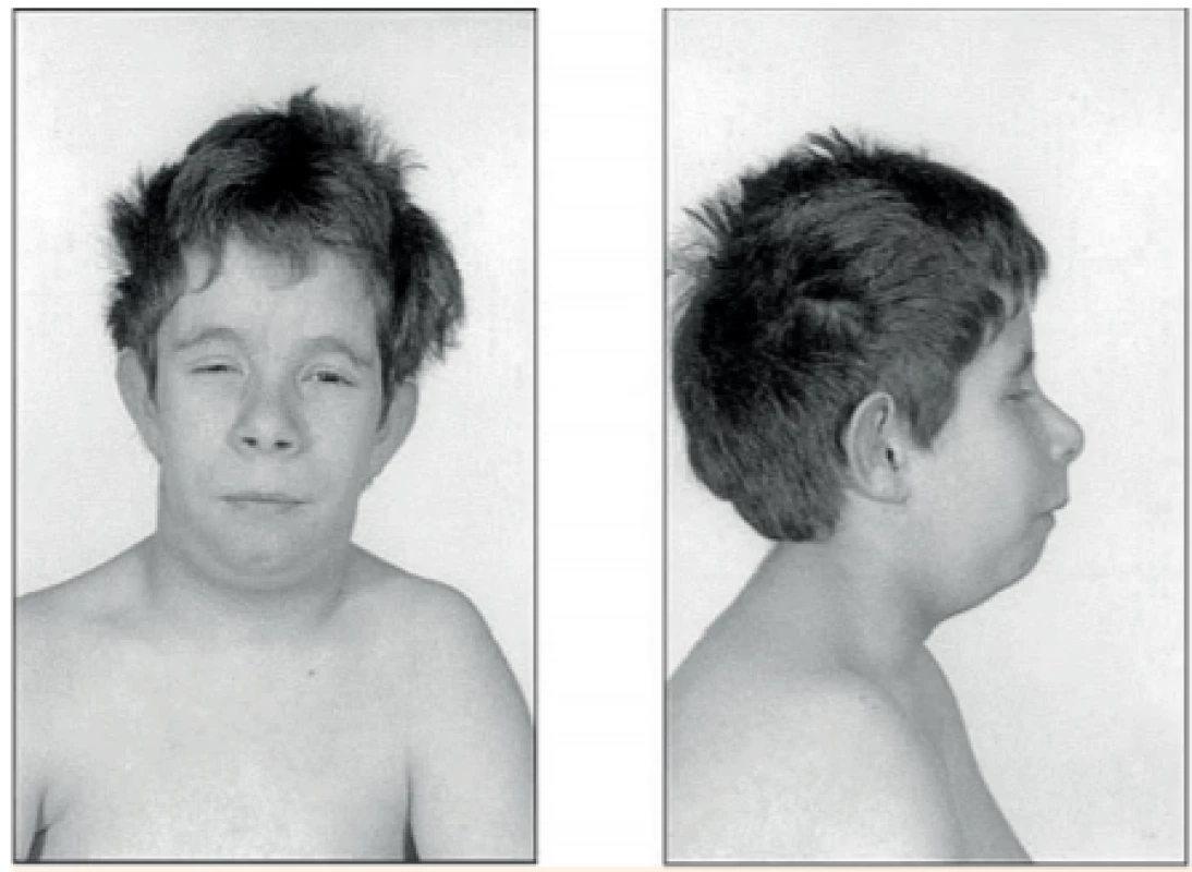 Fenotyp prvního diagnostikovaného pacienta s bialelickou delecí genu pro IGF-I. Chlapec prodělal těžkou
intrauterinní růstovou retardaci (porodní hmotnost
-3,9 SD). V 15 letech měl mikrocefalii, mentální retardaci, poruchu sluchu a závažnou růstovou poruchu (tělesná výška -6,9 SD). IGF-I bylo nedetekovatelné, IGF-BP3
5,8 mg/l, hladina inzulinu nalačno 27,3 mIU/l a hladina
růstového hormonu po stimulaci 61 μg/l (122 mIU/l)
(snímky a kazuistické informace převzaty z [21]).<br>
Fig. 3. Phenotype of the first diagnosed patient with biallelic IGF-I gene deletion. He suffered from severe
intrauterine growth restriction (birth weight -3.9 SD).
At age 15 years, he was microcephalic, intellectually
disabled, had hearing impairment and severely short
stature (body height -6.9 SD). IGF-I was undetectable,
IGFBP-3 5.8 mg/l, fasting insulin 27.3 mIU/l and stimulated growth hormone 61 μg/l (122 mIU/l) (photos and
clinical information overtaken from [21]).